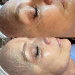 BA-Facial-1-treatment